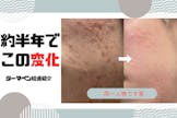 一目でわかる変化！ダーマペン施術前からの様子 第2弾