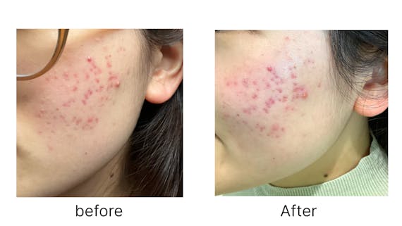 美容鍼ニキビビフォアフ